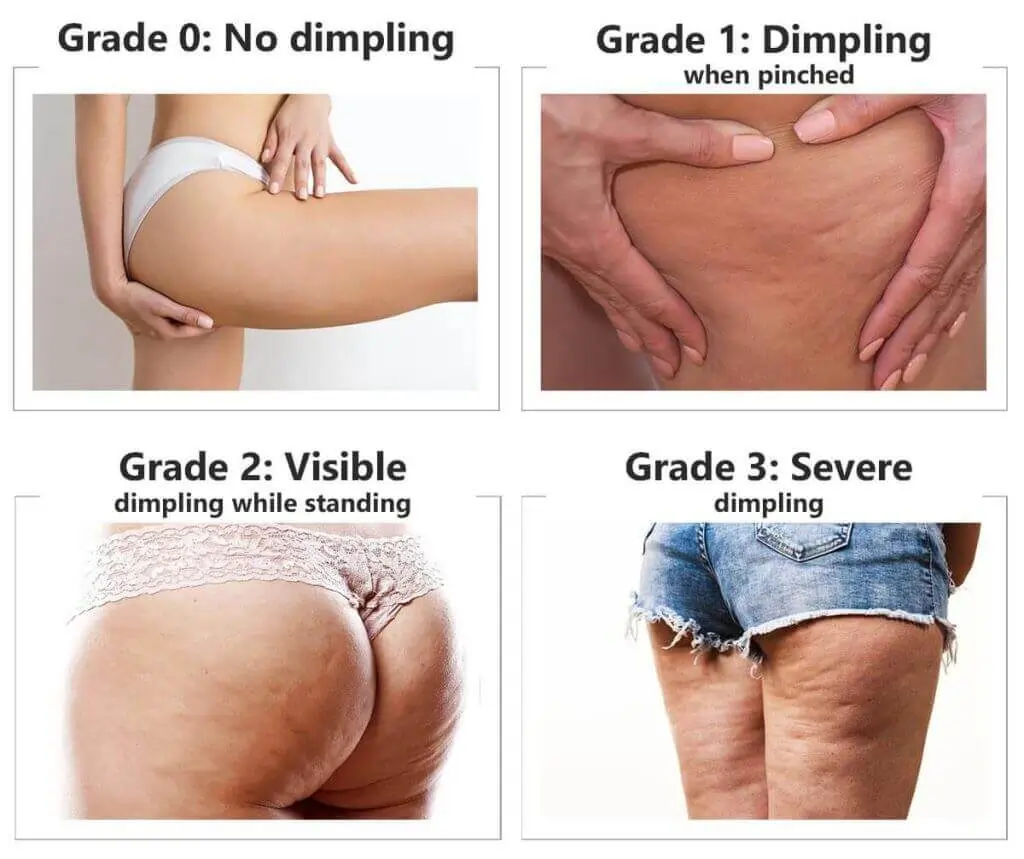 Representation of the stages of cellulite development Dunstable